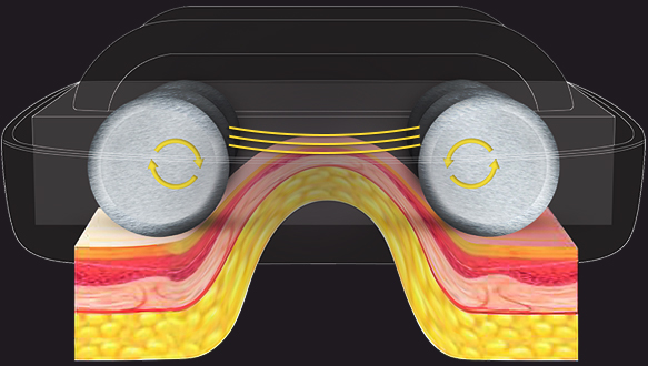 The unique bipolar RF with light type of frequency that heats the subcutaneous tissue light penetrations.