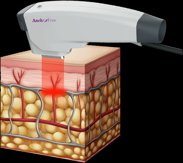 Different frequency energy can treat different depth of skin layers and specially can work on SMAS fascial layer directly.