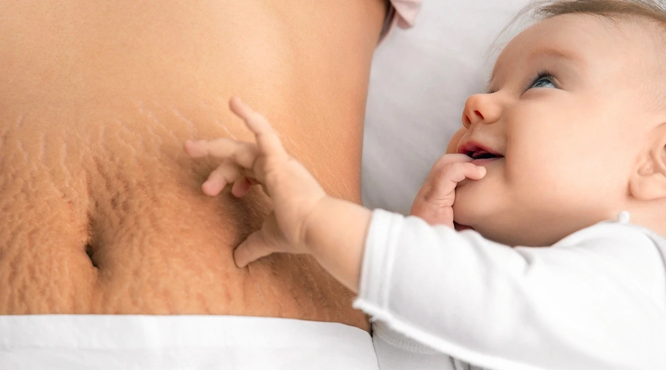 What Is the Best Laser Treatment for Stretch Marks After Pregnancy