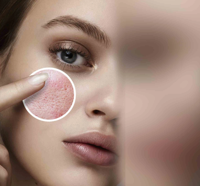 Laser à fibre Erbium 1550 nm pour l'élimination des cicatrices de varicelle