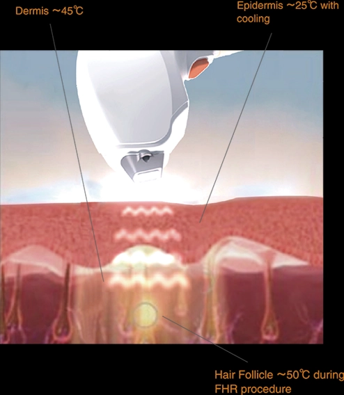 The Truth About 808nm Diode Laser Hair Removal and Your Skin