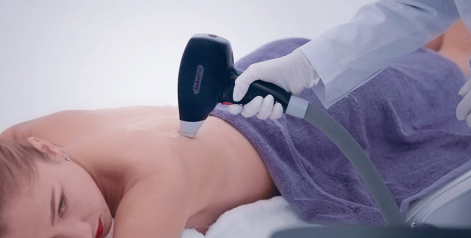 808nm Diode Laser Hair Removal