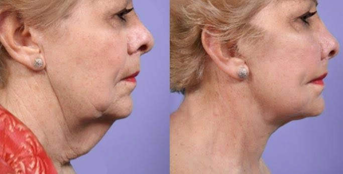 Can Red Light Therapy Tame the Turkey Neck?