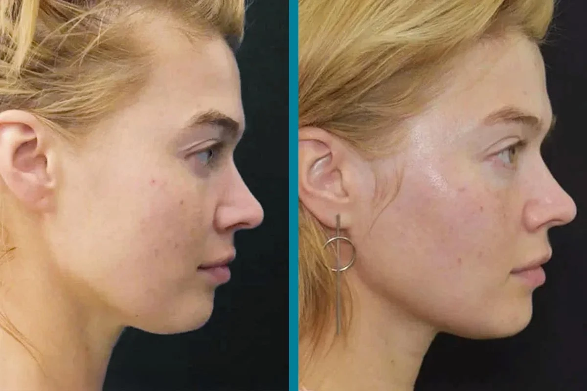 How Often Can You Do RF Skin Tightening
