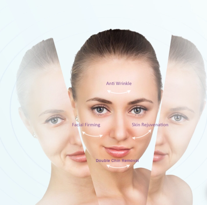 Radiofrequency Skin Tightening: An Alternative to Face Lifts