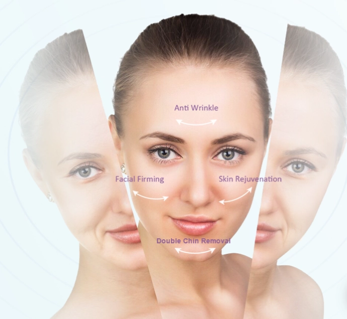 Radio Frequency Skin Tightening